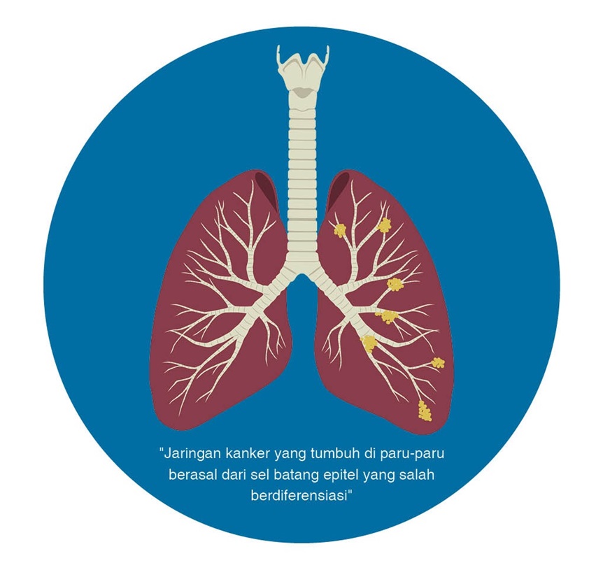 kanker paru